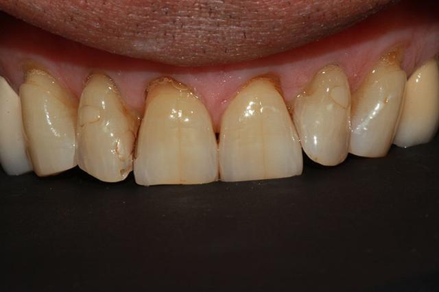 Smile Makeover before at McDonald & Luck DDS in Plano, TX
