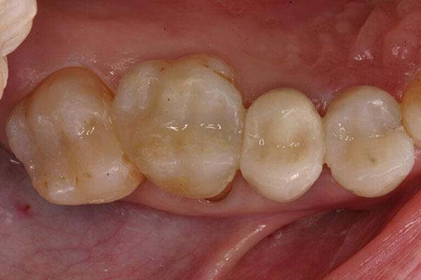 McDonald & Luck DDS smile makeover after — Plano, TX