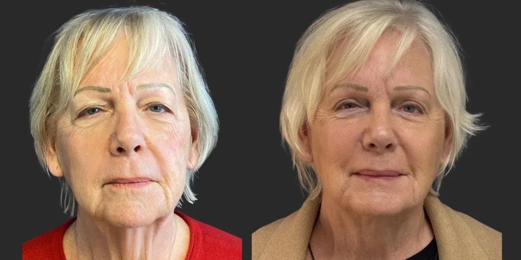 Partington Plastic Surgery and Laser Center facelift result — Bellevue, WA