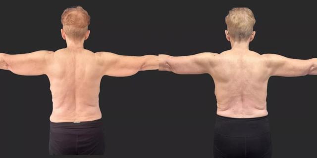 Arm Lift result at Partington Plastic Surgery and Laser Center in Bellevue, WA