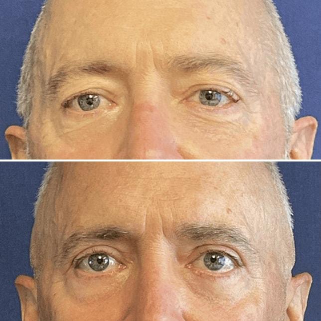 Partington Plastic Surgery and Laser Center eyelid lift result — Bellevue, WA