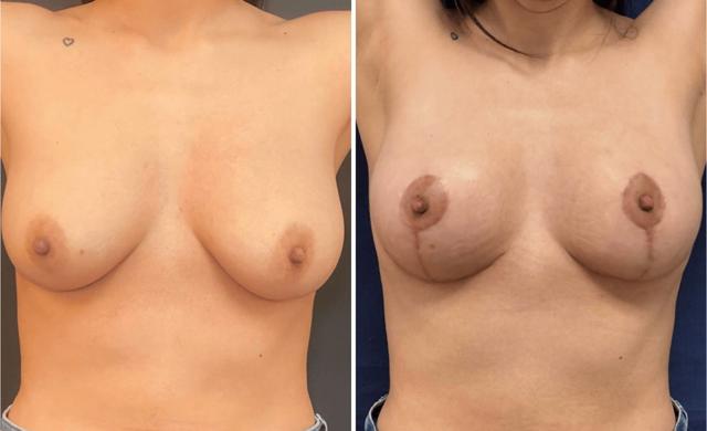Breast Lift result at Partington Plastic Surgery and Laser Center in Bellevue, WA