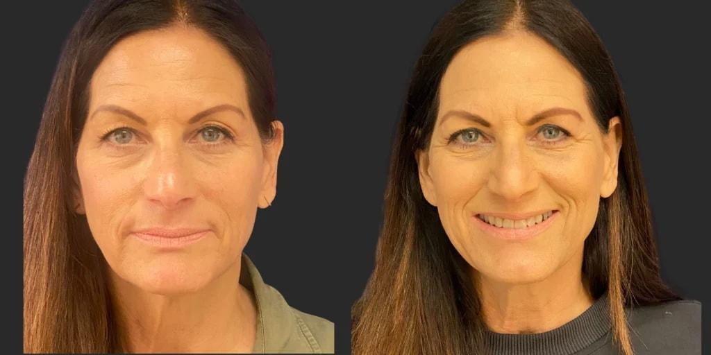 Partington Plastic Surgery and Laser Center eyelid lift result — Bellevue, WA