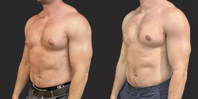Gynecomastia Surgery result at Partington Plastic Surgery and Laser Center in Bellevue, WA