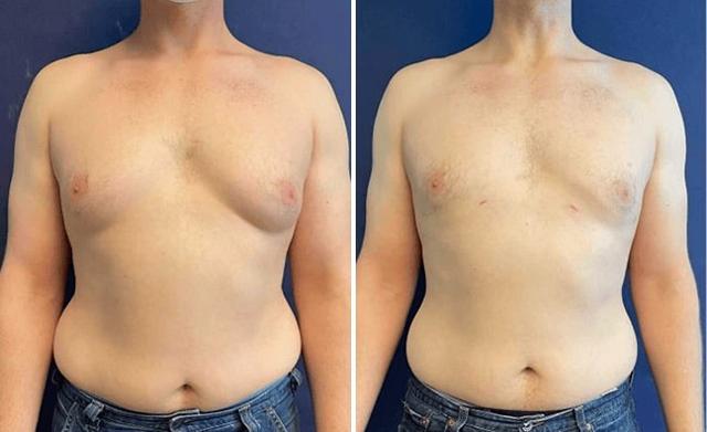 Gynecomastia Surgery result at Partington Plastic Surgery and Laser Center in Bellevue, WA