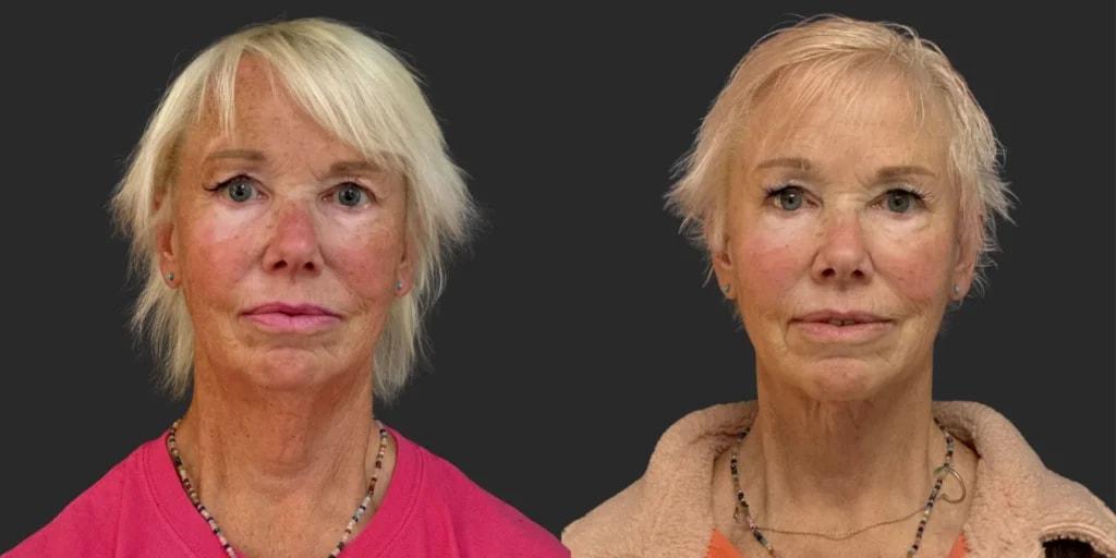Partington Plastic Surgery and Laser Center facelift result — Bellevue, WA
