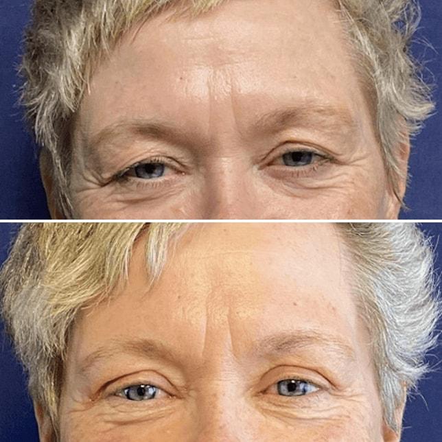 Partington Plastic Surgery and Laser Center eyelid lift result — Bellevue, WA