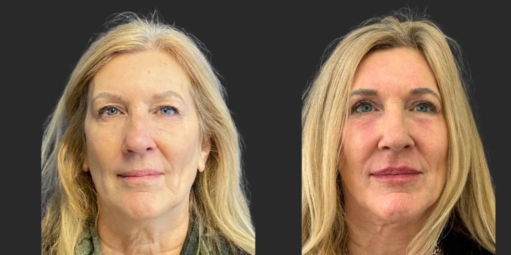 Partington Plastic Surgery and Laser Center rhinoplasty result — Bellevue, WA