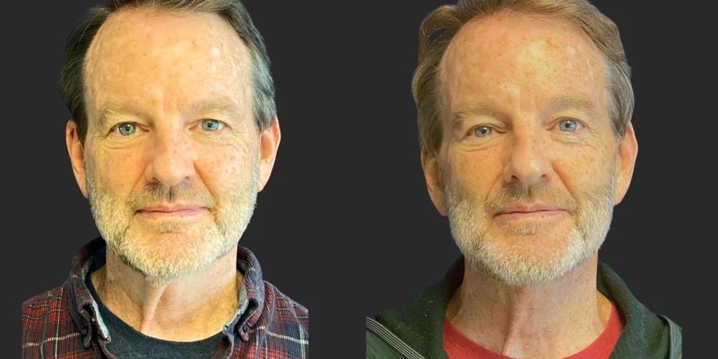 Partington Plastic Surgery and Laser Center facelift result — Bellevue, WA