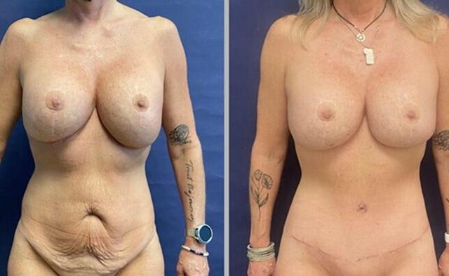 Mommy Makeover result at Partington Plastic Surgery and Laser Center in Bellevue, WA
