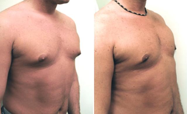 Gynecomastia Surgery result at Partington Plastic Surgery and Laser Center in Bellevue, WA