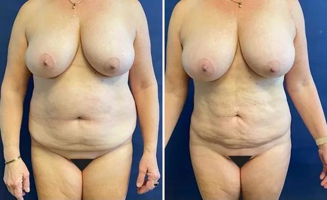Liposuction result at Partington Plastic Surgery and Laser Center in Bellevue, WA
