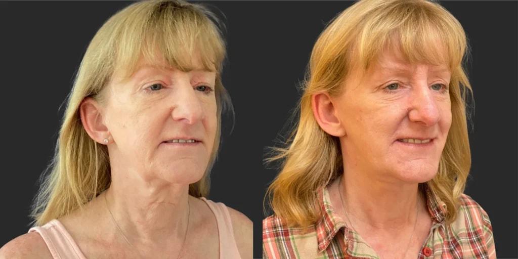 Partington Plastic Surgery and Laser Center facelift result — Bellevue, WA