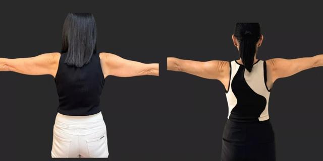 Arm Lift result at Partington Plastic Surgery and Laser Center in Bellevue, WA
