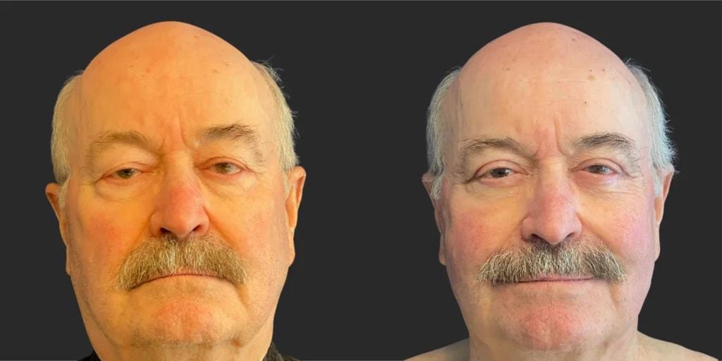 Partington Plastic Surgery and Laser Center eyelid lift result — Bellevue, WA
