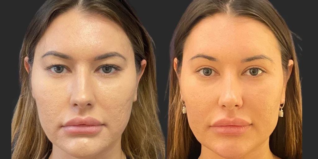 Partington Plastic Surgery and Laser Center eyelid lift result — Bellevue, WA