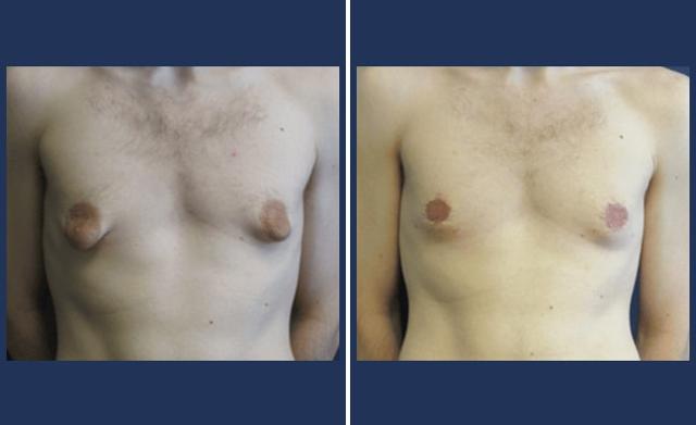 Gynecomastia Surgery result at Partington Plastic Surgery and Laser Center in Bellevue, WA