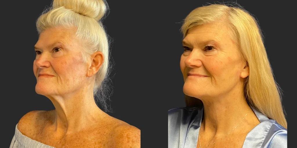 Partington Plastic Surgery and Laser Center facelift result — Bellevue, WA