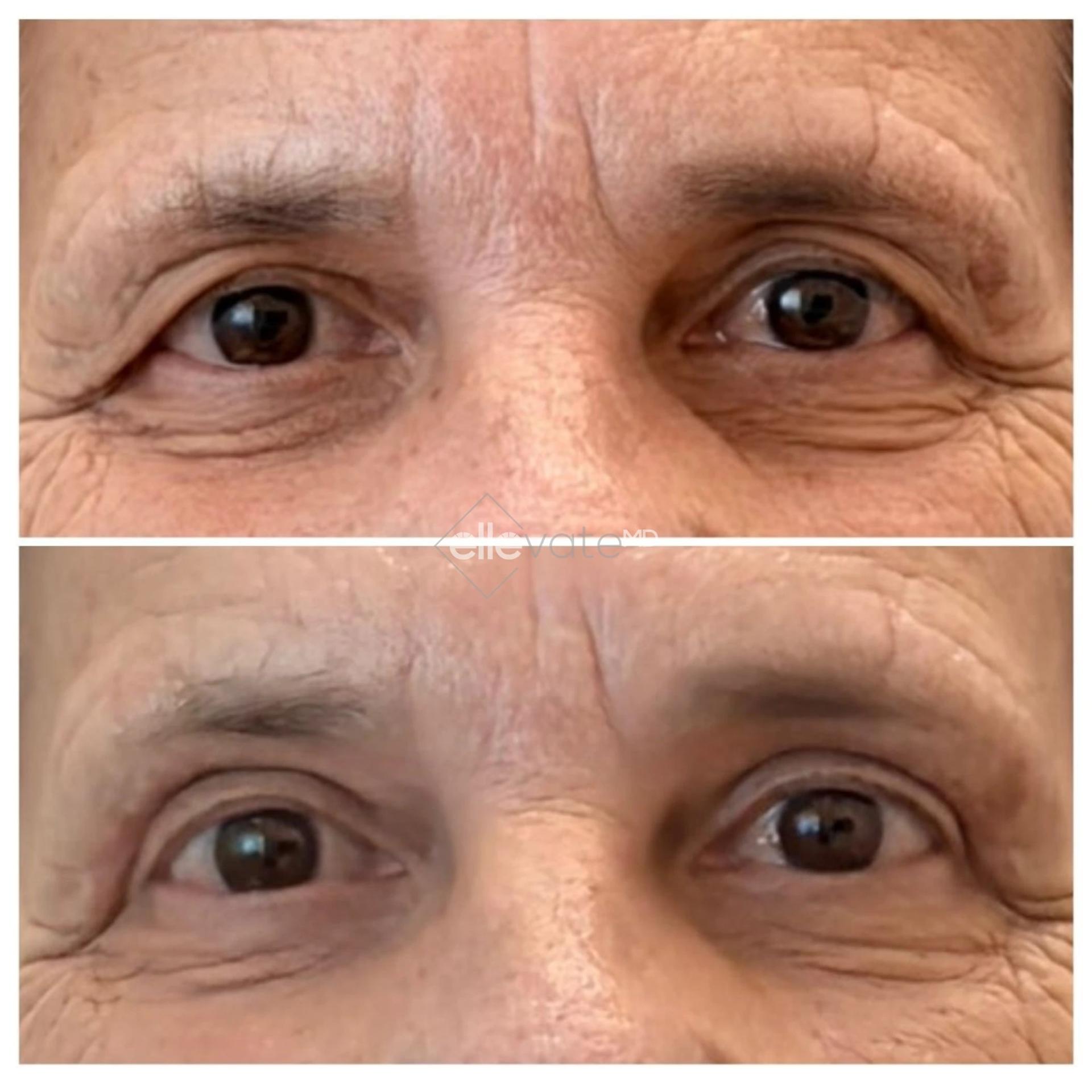 ellevateMD (Ann Jayaram, MD) eyelid lift result — Atherton, CA