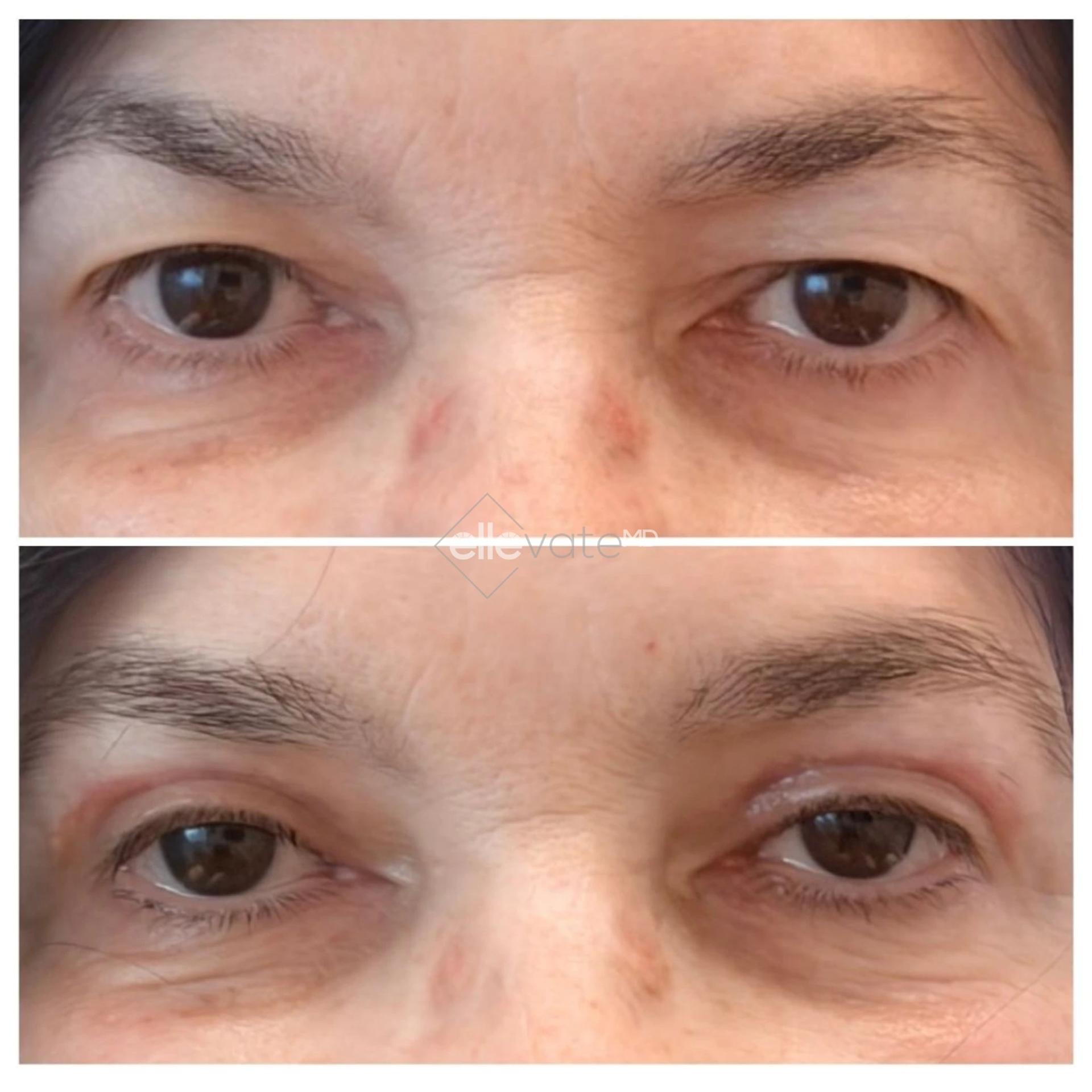 ellevateMD (Ann Jayaram, MD) eyelid lift result — Atherton, CA