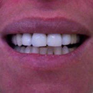 DV Dentistry smile makeover after — Costa Mesa, CA
