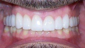 DV Dentistry smile makeover after — Costa Mesa, CA
