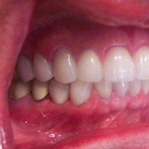 DV Dentistry smile makeover after — Costa Mesa, CA