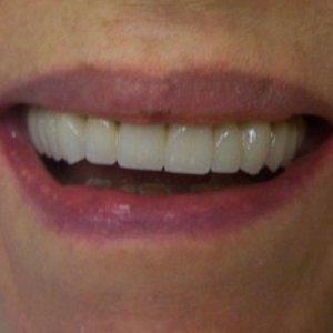 DV Dentistry smile makeover after — Costa Mesa, CA