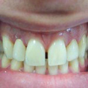 Dental Crowns after at DV Dentistry in Costa Mesa, CA