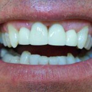 Dental Veneers after at DV Dentistry in Costa Mesa, CA