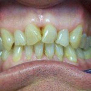 Dental Veneers before at DV Dentistry in Costa Mesa, CA