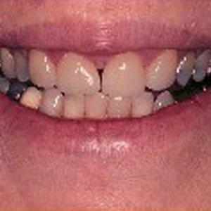 DV Dentistry smile makeover after — Costa Mesa, CA