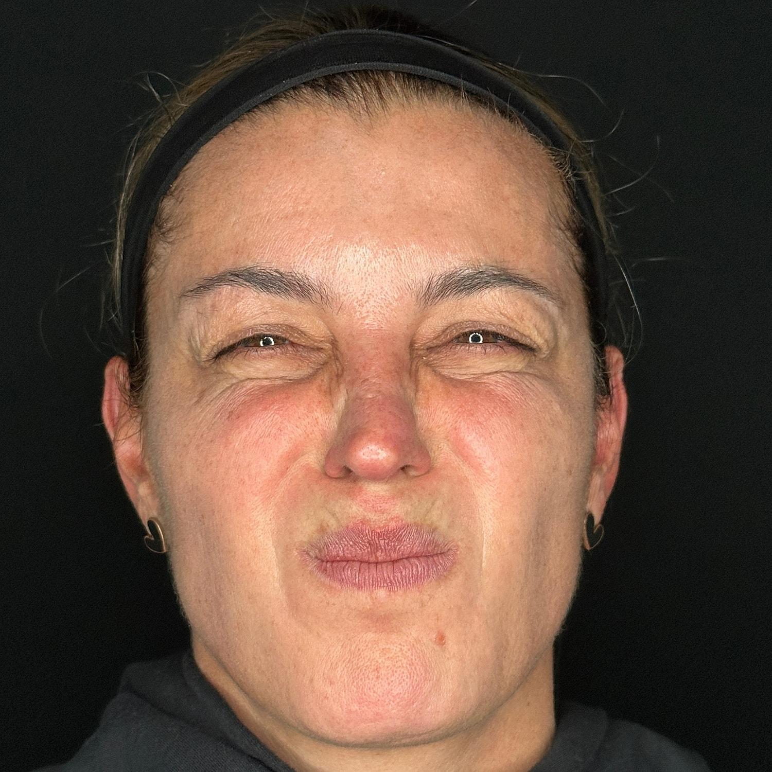 Miami Skin and Vein (Shaun Patel, MD) botox after — Coral Gables, FL