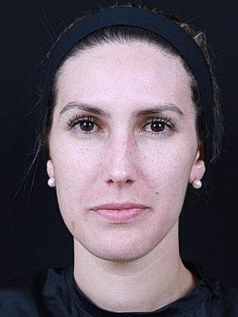 Chemical Peel after at Miami Skin and Vein (Shaun Patel, MD) in Coral Gables, FL