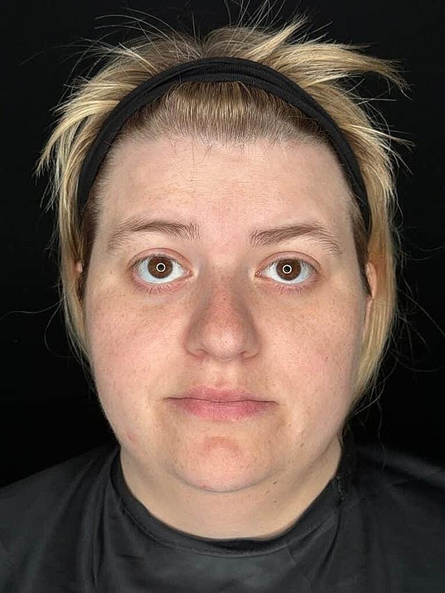 Chemical Peel before at Miami Skin and Vein (Shaun Patel, MD) in Coral Gables, FL