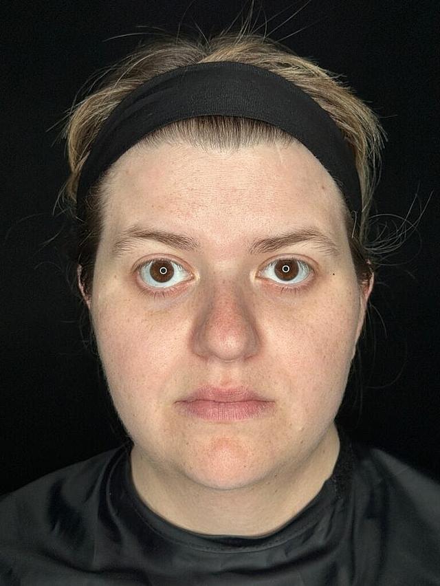 Chemical Peel after at Miami Skin and Vein (Shaun Patel, MD) in Coral Gables, FL