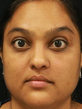 Miami Skin and Vein (Shaun Patel, MD) botox after — Coral Gables, FL