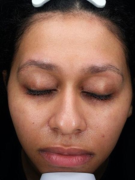 Laser Skin Resurfacing before at Miami Skin and Vein (Shaun Patel, MD) in Coral Gables, FL