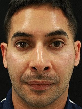 Miami Skin and Vein (Shaun Patel, MD) botox after — Coral Gables, FL