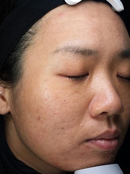 Laser Skin Resurfacing after at Miami Skin and Vein (Shaun Patel, MD) in Coral Gables, FL
