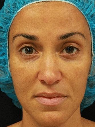 Miami Skin and Vein (Shaun Patel, MD) botox after — Coral Gables, FL