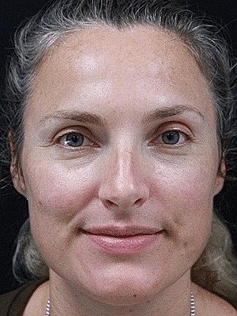 Chemical Peel before at Miami Skin and Vein (Shaun Patel, MD) in Coral Gables, FL