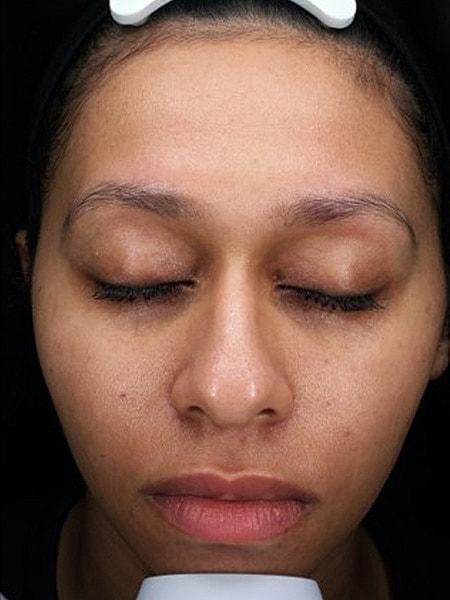 Laser Skin Resurfacing after at Miami Skin and Vein (Shaun Patel, MD) in Coral Gables, FL