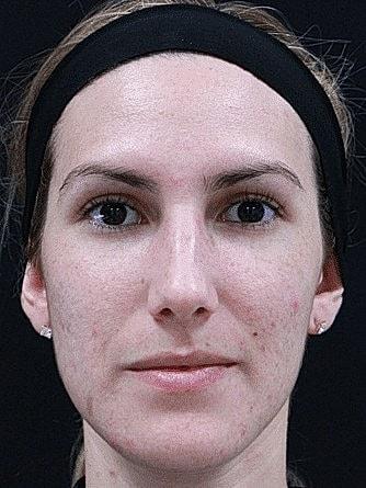 Chemical Peel before at Miami Skin and Vein (Shaun Patel, MD) in Coral Gables, FL