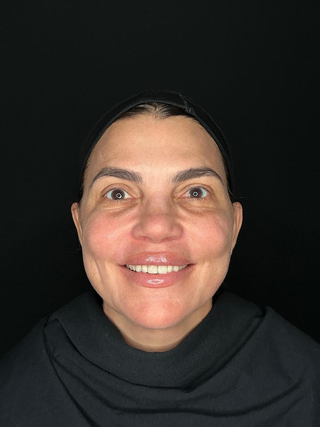 Miami Skin and Vein (Shaun Patel, MD) botox after — Coral Gables, FL