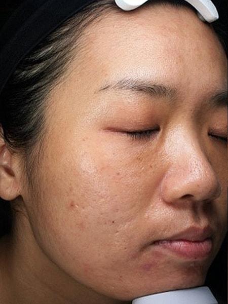 Laser Skin Resurfacing before at Miami Skin and Vein (Shaun Patel, MD) in Coral Gables, FL