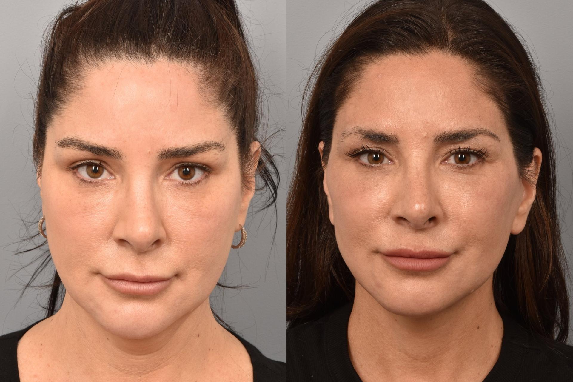 Meryam Shikara, MD facelift result — New York, NY