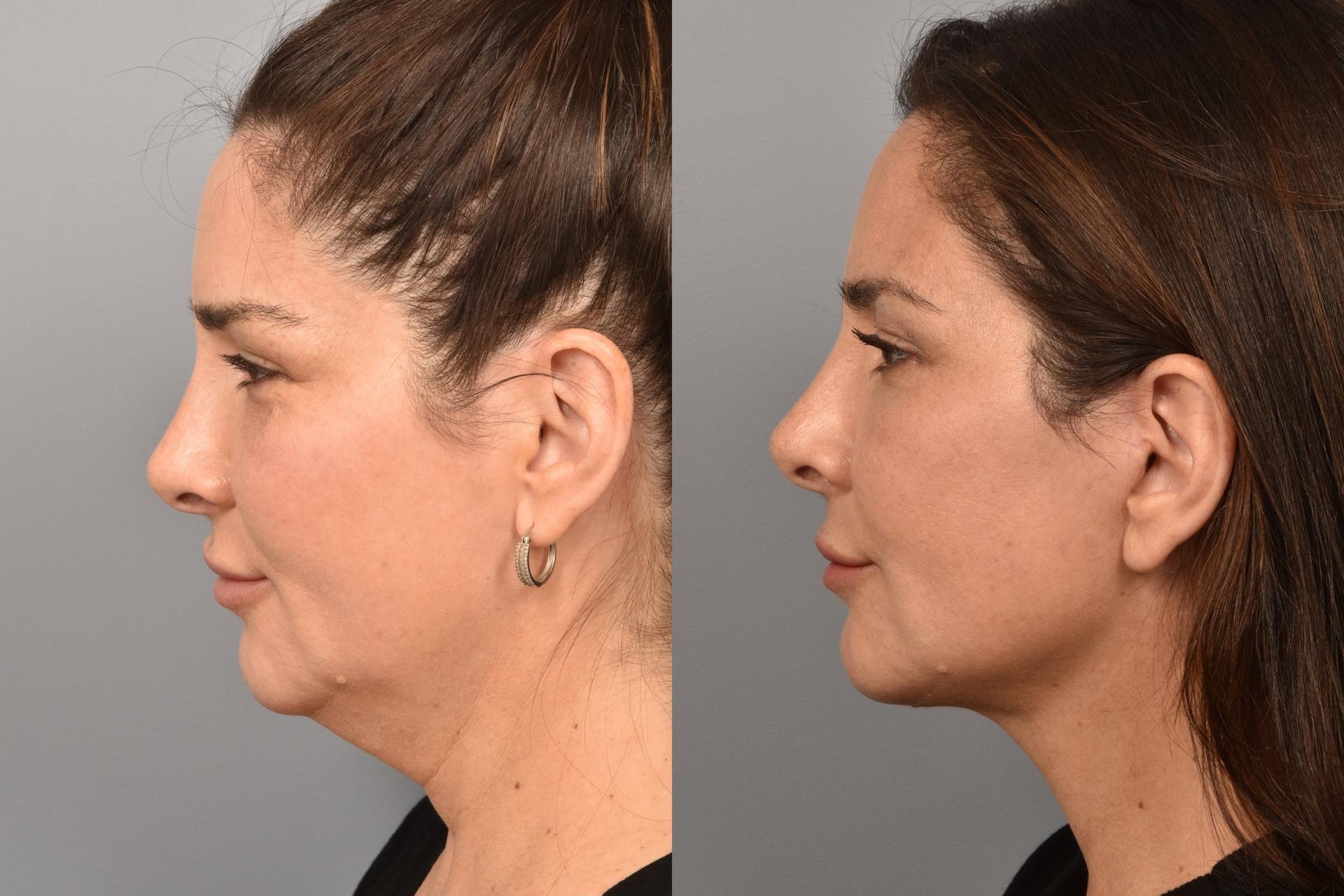 Meryam Shikara, MD facelift result — New York, NY