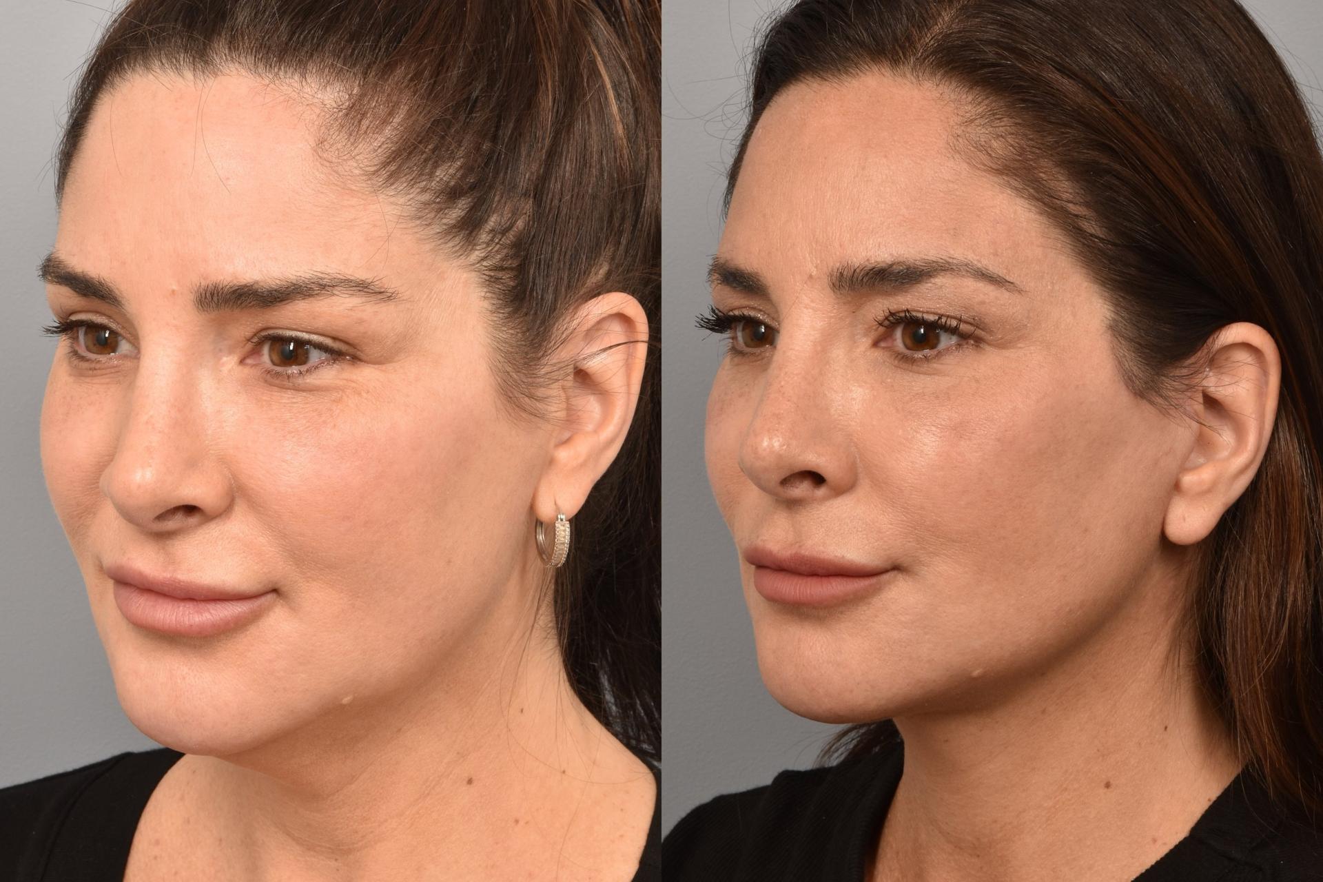 Meryam Shikara, MD facelift result — New York, NY