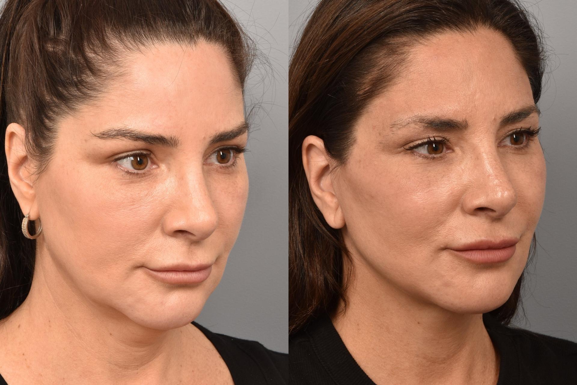Meryam Shikara, MD facelift result — New York, NY